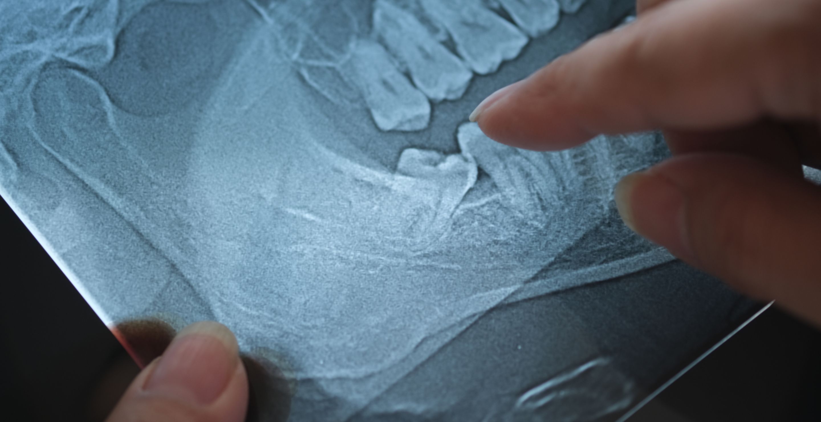 23-Year-Old Almost Dies When Impacted Wisdom Tooth Causes Life-Threatening Infection