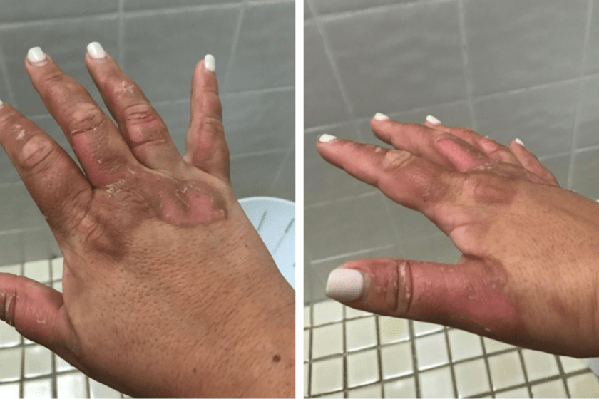 Margarita Burn is a Real Thing (And How You Can Avoid It)